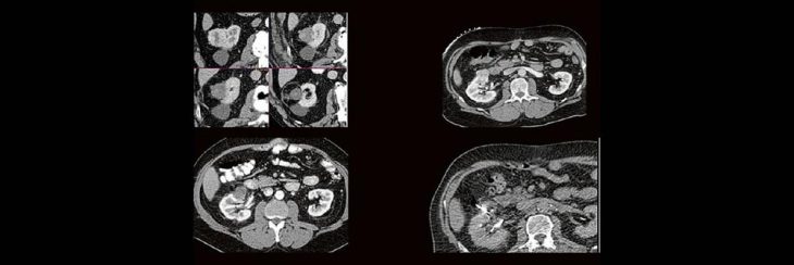Thermoablation von Nierentumoren (Webinar | Online)